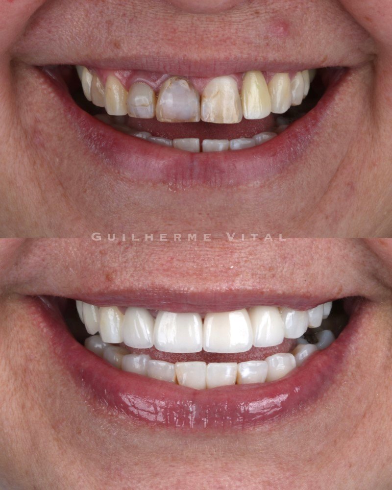 antes.depois.001 (Personalizado)