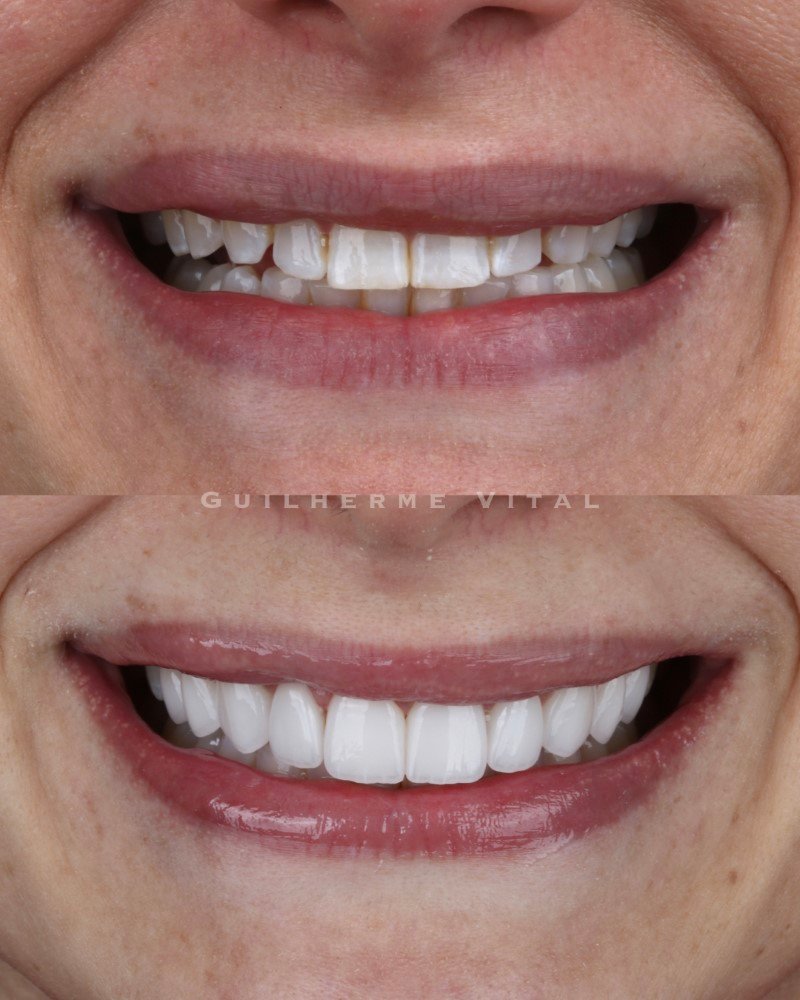 antes.depois.002 (Personalizado)