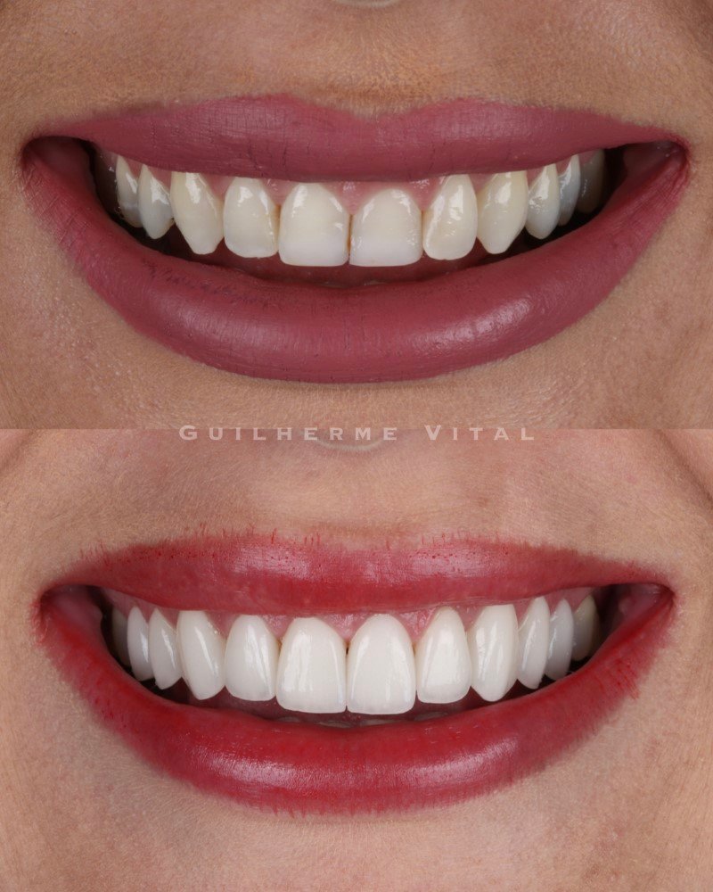 antes.depois.006 (Personalizado)