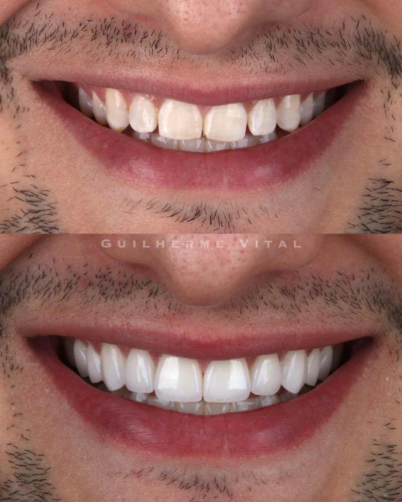 antes.depois.007 (Personalizado)