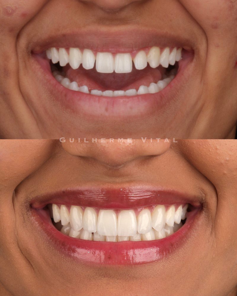 antes.depois.009 (Personalizado)