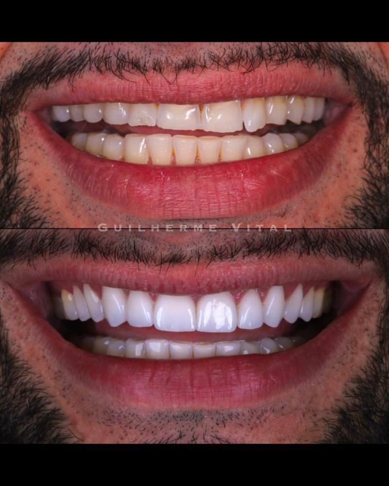 antes.depois.012 (Personalizado)
