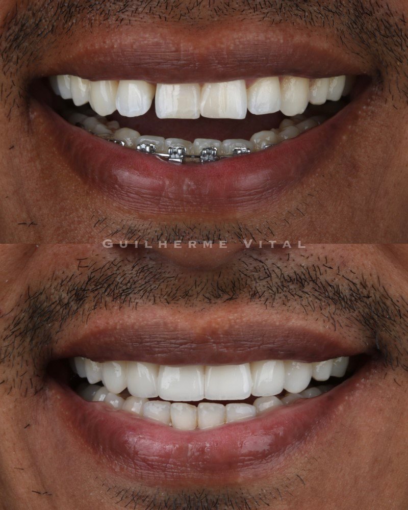 antes.depois.014 (Personalizado)